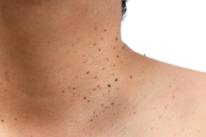SKIN TAG