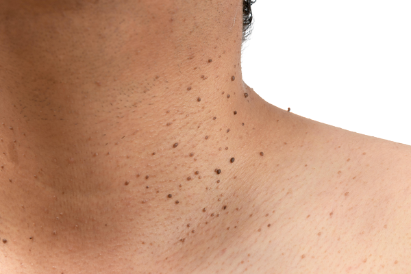 SKIN TAG
