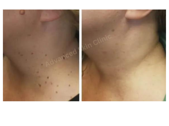 SKIN TAG REMOVAL
