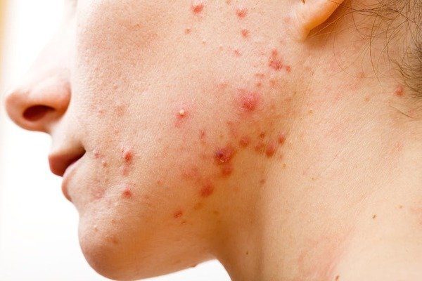 Acne Clinic -ASC
