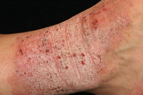 Eczema