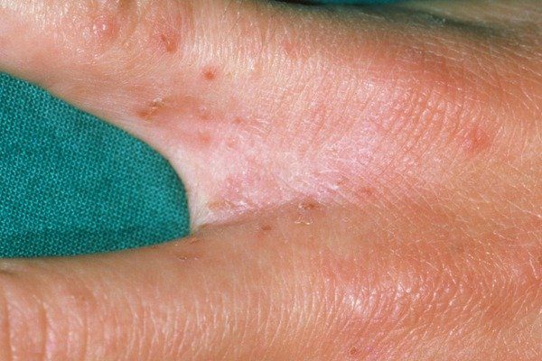 Scabies