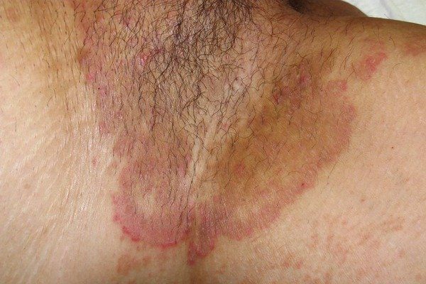 Tinea