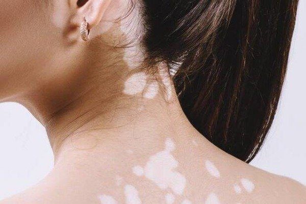 Vitiligo