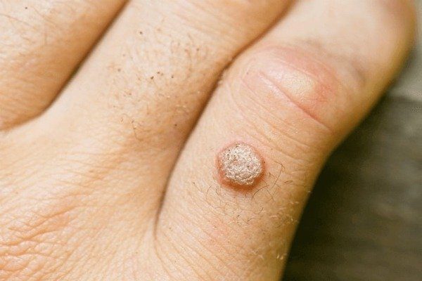 Wart