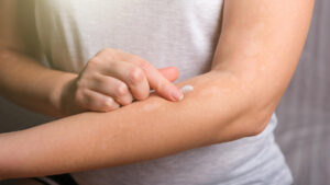VITILIGO