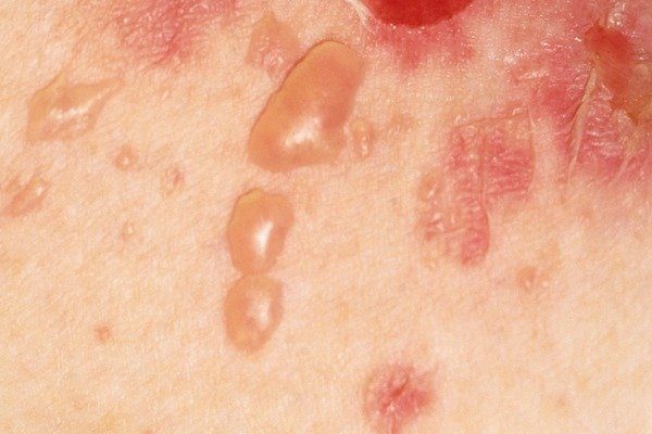 pemphigus vulgaris
