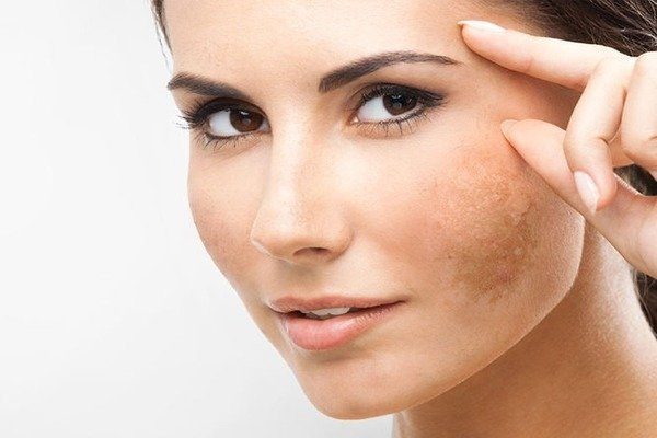Pigmentation
