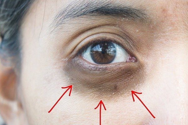 UNDER EYE DARKNESS